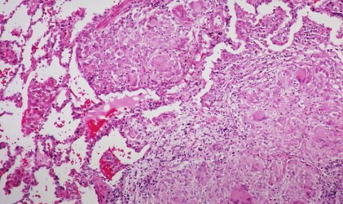Sarcoidosis. Non necrotizing granulomas. © Yale Rosen