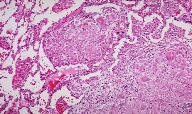 Sarcoidosis. Non necrotizing granulomas. © Yale Rosen